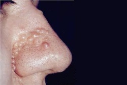 Adenoma sebaceo
