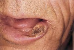 Cheilite Attinica