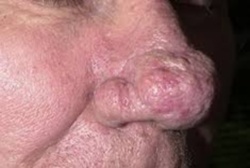 Iperplasia sebacea della rosacea