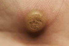 Verruche delle mani